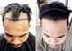 Slider image (9) The Best Medical Hair Center by Dr. Orn 